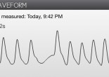 Waveform showing skipped beat